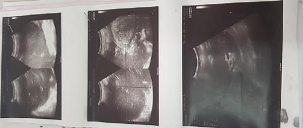 Sau sinh con gần 1 tháng, bác sĩ kinh hoàng nhìn cảnh tượng bên trong bụng bà mẹ Hà Nội-1