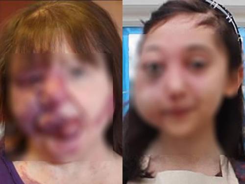 Biến dạng kinh khủng cả khuôn mặt vì tẩy nốt ruồi sai cách, chị em nên cảnh giác cao độ-1