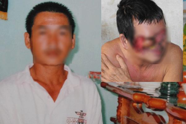 Biến dạng kinh khủng cả khuôn mặt vì tẩy nốt ruồi sai cách, chị em nên cảnh giác cao độ-4