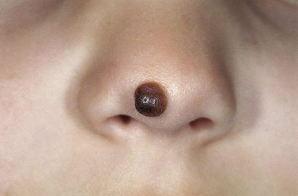 Biến dạng kinh khủng cả khuôn mặt vì tẩy nốt ruồi sai cách, chị em nên cảnh giác cao độ-5