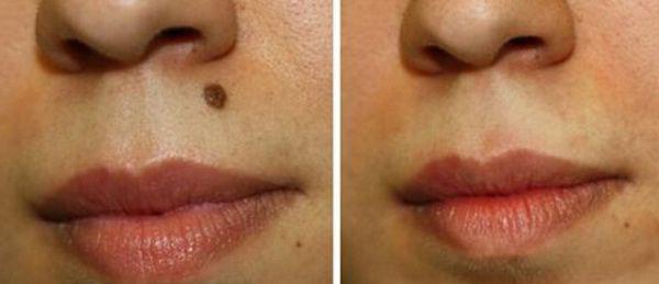 Biến dạng kinh khủng cả khuôn mặt vì tẩy nốt ruồi sai cách, chị em nên cảnh giác cao độ-7