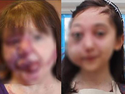 Dắt túi những kiến thức cực hữu ích về cách trị mụn ruồi-4