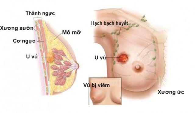 Tắm chung với con gái, mẹ phát hiện điểm bất thường trên ngực nhờ đó cứu sống con-1