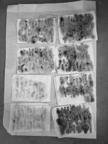 Tắm chung với con gái, mẹ phát hiện điểm bất thường trên ngực nhờ đó cứu sống con-2