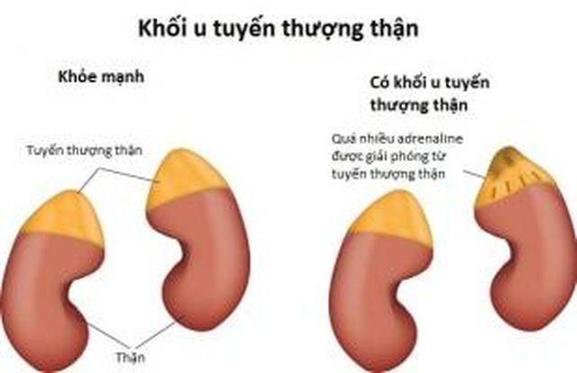 Cha sững người khi ngực con trai to như quả cam, không ngờ đi khám mắc bệnh hiếm gặp-2