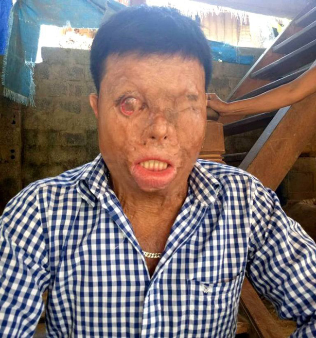 Phận đời khốn khổ của chàng thanh niên bị tạt axit nhầm-1