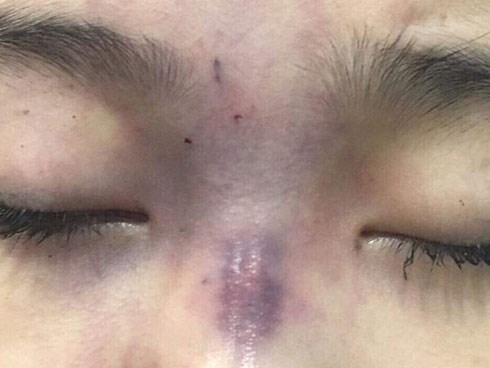 Chồng tiêm filler làm mù mắt vợ