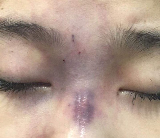 Chồng tiêm filler làm mù mắt vợ-1