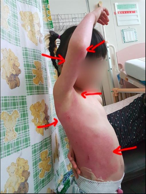 Con gái 5 tuổi bị bỏng nặng, kiểm tra camera trong trường mẫu giáo bố mẹ càng phẫn nộ hơn-4