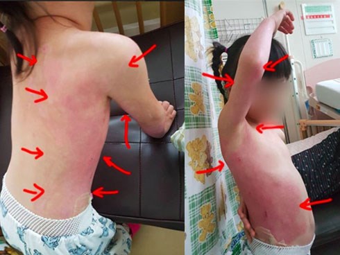 Con gái 5 tuổi bị bỏng nặng, kiểm tra camera trong trường mẫu giáo bố mẹ càng phẫn nộ hơn