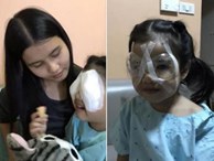 Hành động sai lầm của cha khi cho con ăn cơm khiến bé gái 4 tuổi phải phẫu thuật mắt