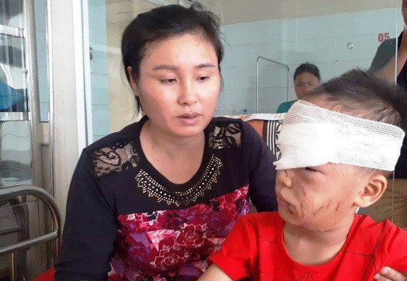 Bé trai 6 tuổi ở bị chó nhà cắn nát mặt-1