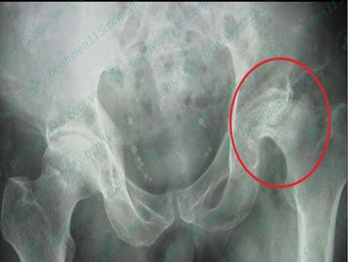 Dọn nhà, người phụ nữ bị hoại tử 8 ngón tay đen sì: Triệu chứng bất thường mọi người phải hết sức cảnh giác-5