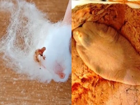 Tưởng mụn ở ngực, cô gái Sơn La nặn ra con sán ngoe nguẩy