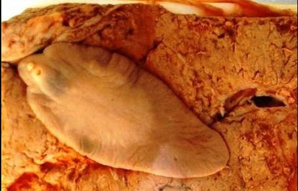 Tưởng mụn ở ngực, cô gái Sơn La nặn ra con sán ngoe nguẩy-3