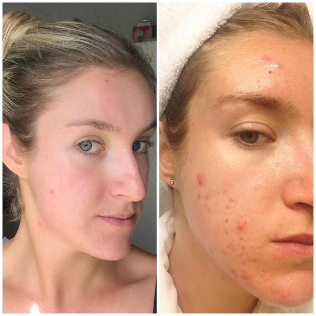 Dư thừa estrogen có thể gây ung thư ở phụ nữ và đây là 8 dấu hiệu nhận biết-1