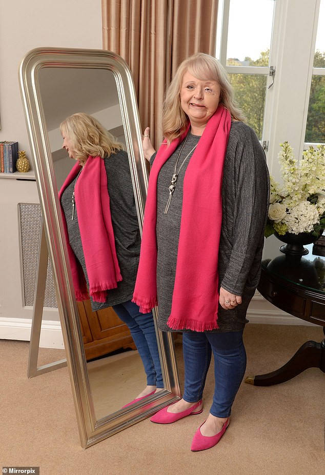 Người phụ nữ bị vi khuẩn ăn hết nửa khuôn mặt: Đừng chủ quan dù chỉ có một vết xước nhỏ!-1