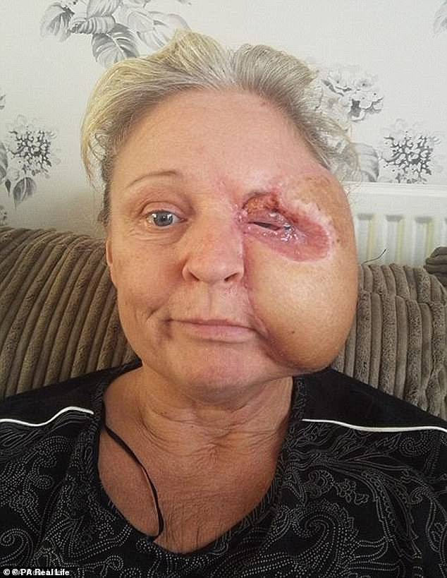 Người phụ nữ bị vi khuẩn ăn hết nửa khuôn mặt: Đừng chủ quan dù chỉ có một vết xước nhỏ!-2