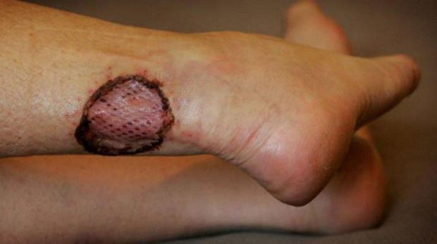 Người phụ nữ bị vi khuẩn ăn hết nửa khuôn mặt: Đừng chủ quan dù chỉ có một vết xước nhỏ!-4