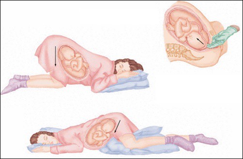 Sờ thấy tay thai nhi và dây rốn ở vùng kín sản phụ, bác sĩ đã làm 1 việc cứu sống cả mẹ và con-8