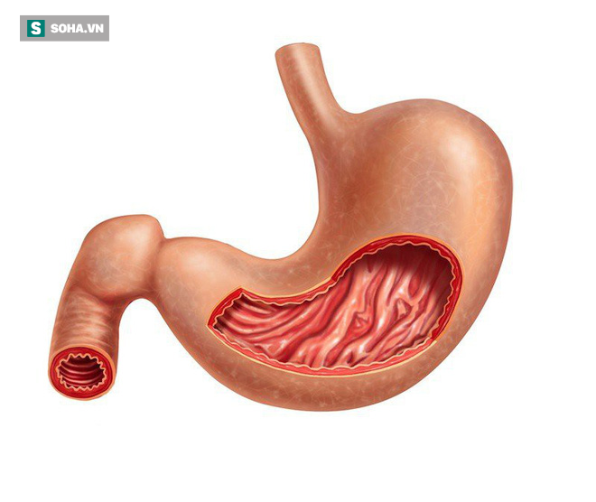 4 yếu tố nguy cơ gây ung thư dạ dày: Bạn cần khám sớm để phát hiện có mầm bệnh hay không-1