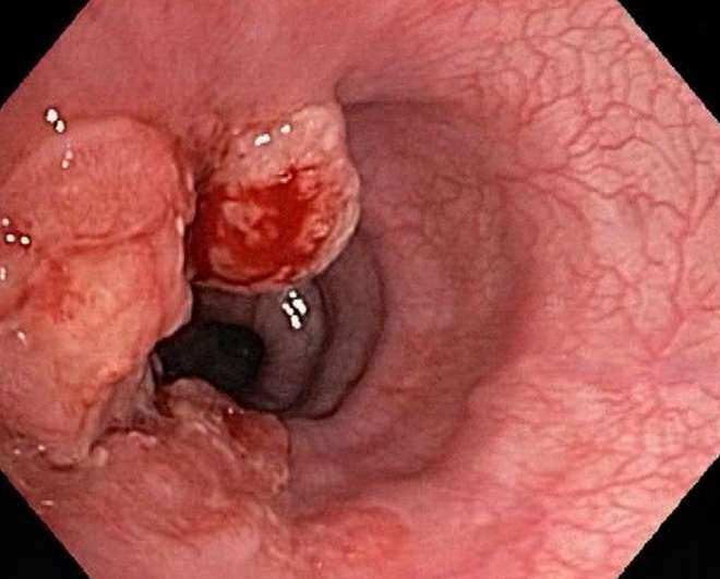 4 yếu tố nguy cơ gây ung thư dạ dày: Bạn cần khám sớm để phát hiện có mầm bệnh hay không-3