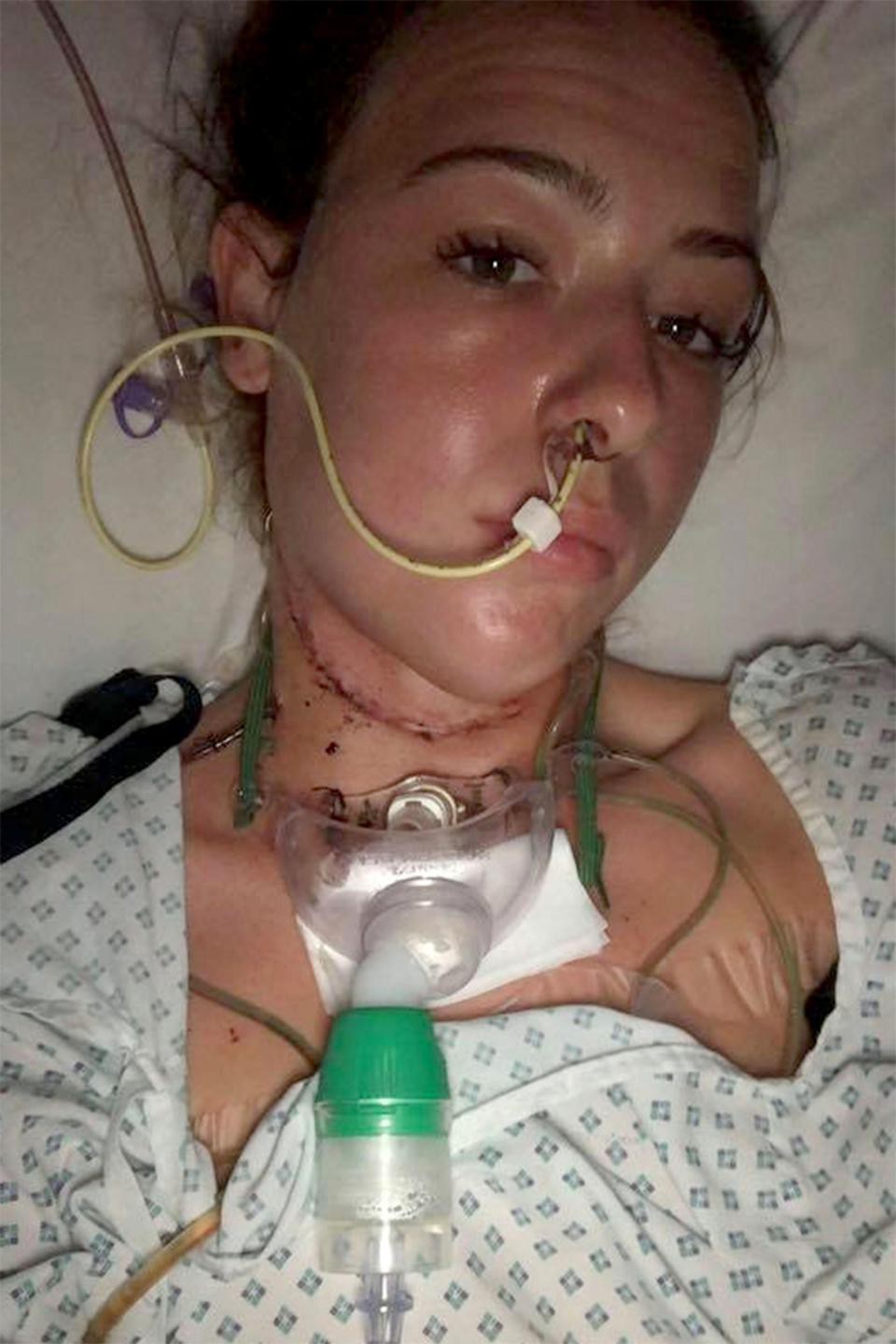 Có vết loét trong miệng nhưng bác sĩ cũng không ngờ là dấu hiệu ung thư lưỡi - câu chuyện của cô gái đáng thương-1