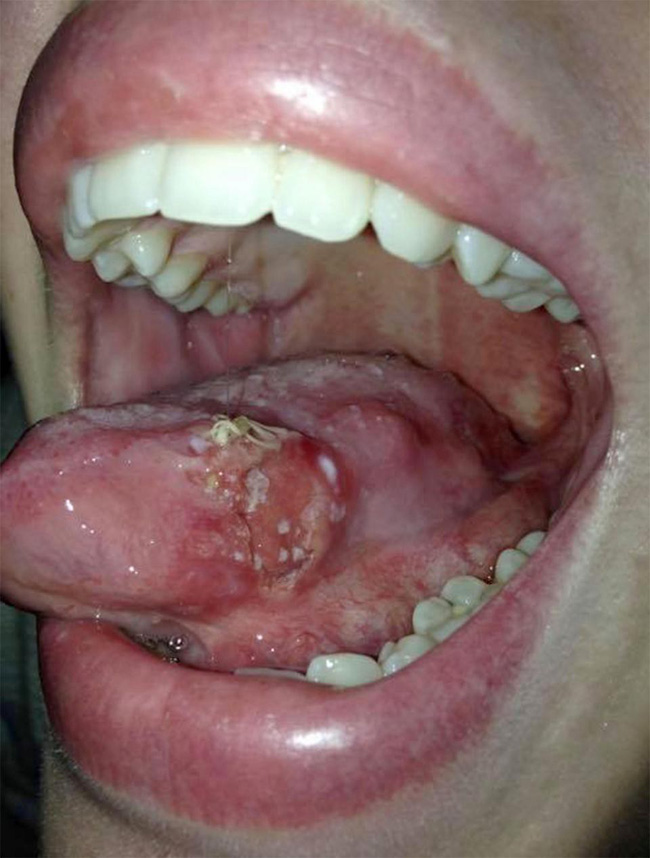 Có vết loét trong miệng nhưng bác sĩ cũng không ngờ là dấu hiệu ung thư lưỡi - câu chuyện của cô gái đáng thương-3