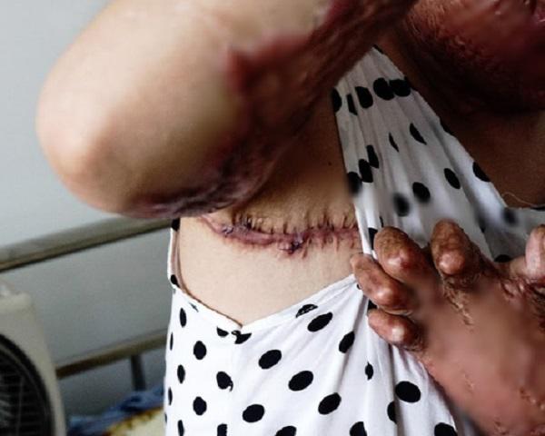 Hồi sinh từ cõi chết, mẹ 9x xinh đẹp bị chồng thiêu sống giờ khao khát kiếm tiền nuôi con-2