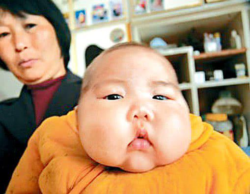 Cháu béo rụt cổ bà vẫn hãnh diện vì mát tay, bác sĩ thảng thốt bệnh ở mức nghiêm trọng-1