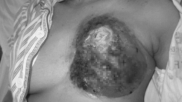 Ung thư vú tại Việt Nam liên tục tăng, khuyến cáo đặc biệt của Giám đốc BV K-1