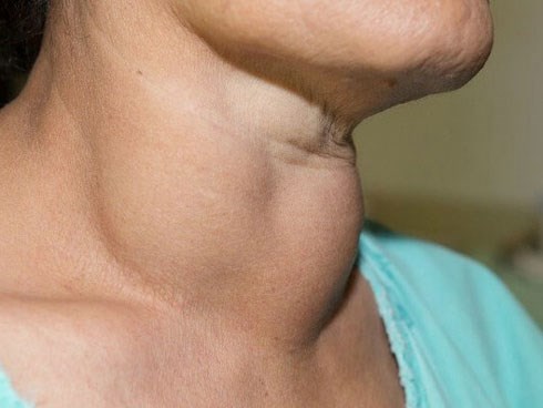 U tuyến giáp khổng lồ khiến cụ bà khó thở suýt chết, phải nhập viện cấp cứu
