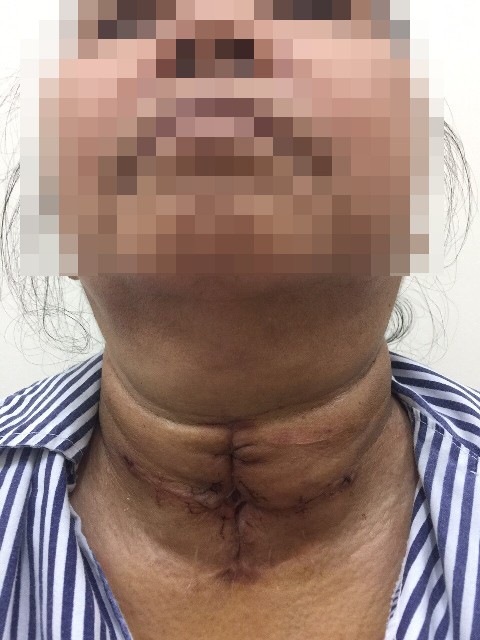 U tuyến giáp khổng lồ khiến cụ bà khó thở suýt chết, phải nhập viện cấp cứu-1