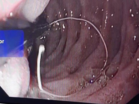 Xem video gắp đỉa trâu dài 15cm ngoe nguẩy trong khí quản người đàn ông-2