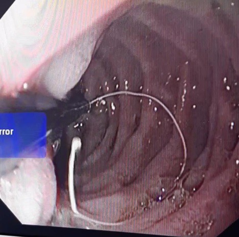 Bé 12 tuổi nuốt phải kim khâu, bác sĩ nội soi gắp ra cả cây kim còn nguyên sợi chỉ cước-2