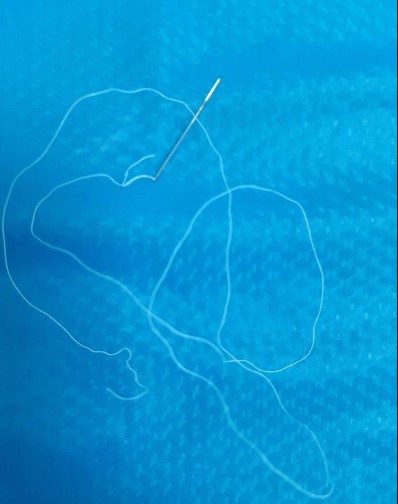 Bé 12 tuổi nuốt phải kim khâu, bác sĩ nội soi gắp ra cả cây kim còn nguyên sợi chỉ cước-3