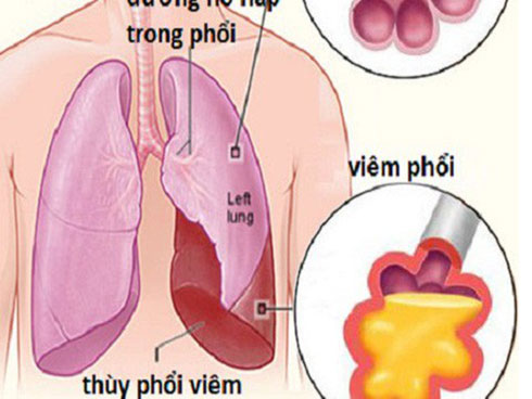 Con gái cảm sốt nhiều ngày, mẹ đưa đến bệnh viện thì phát hiện trong phổi có 600ml mủ và lời cảnh tỉnh về căn bệnh thường gặp ở trẻ-4