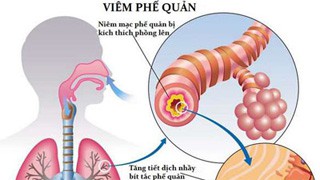 6 bệnh viêm phổi - phế quản thường gặp-2