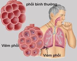 6 bệnh viêm phổi - phế quản thường gặp-3