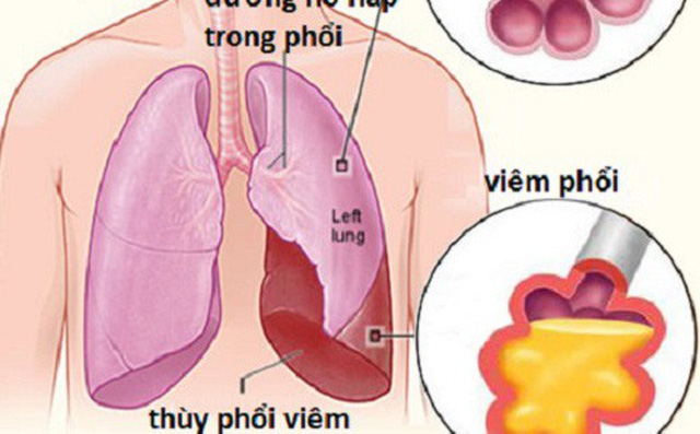 6 bệnh viêm phổi - phế quản thường gặp-1