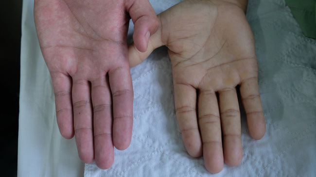 Tỉnh táo với 5 dấu hiệu của bệnh thiếu máu mà không phải ai cũng nhận ra-2