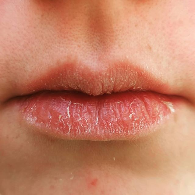 Tỉnh táo với 5 dấu hiệu của bệnh thiếu máu mà không phải ai cũng nhận ra-7