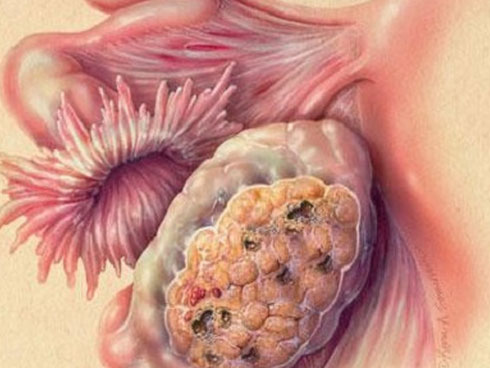 Cậu bé bị ung thư thận vì cả ngày chỉ ăn một món được khuyến cáo không ăn quá nhiều-5