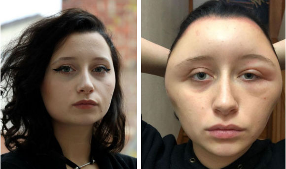 Cô gái bị biến dạng khuôn mặt sau một đêm, nguyên nhân không ngờ là thứ mà đa số chị em đều dùng-1