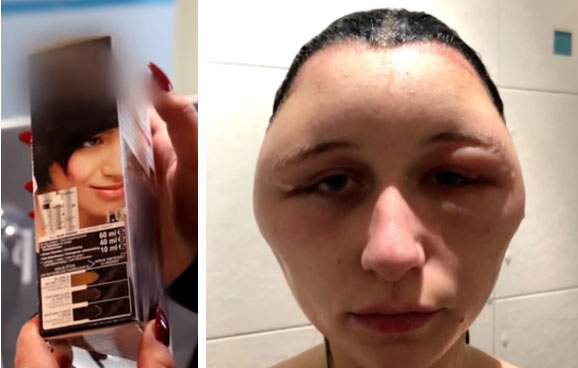 Cô gái bị biến dạng khuôn mặt sau một đêm, nguyên nhân không ngờ là thứ mà đa số chị em đều dùng-2