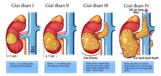 Cậu bé bị ung thư thận vì cả ngày chỉ ăn một món được khuyến cáo không ăn quá nhiều-2