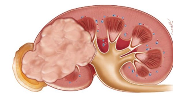 Những điều ít biết về căn bệnh ung thư thận diễn viên Ngọc Căn mắc phải-2