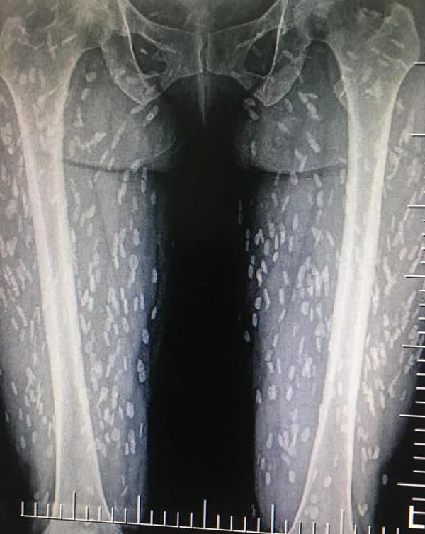 Ảnh X-quang toàn đốm trắng, lý giải của BS khiến nhiều người nghe xong phải bỏ kiểu ăn này-3