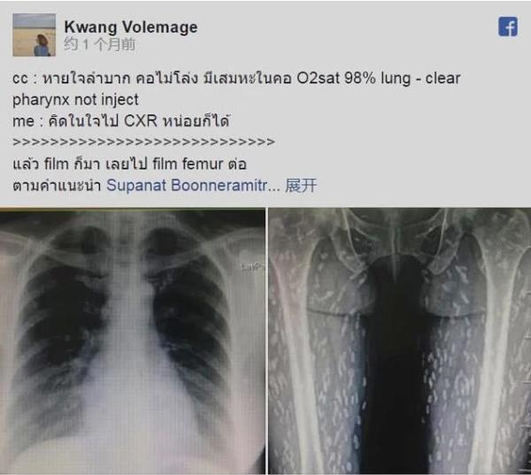 Ảnh X-quang toàn đốm trắng, lý giải của BS khiến nhiều người nghe xong phải bỏ kiểu ăn này-1