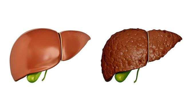 Khi có sự thay đổi này xảy ra ở ngực: 90% khả năng bạn đã bị xơ gan, hãy nhanh đi khám-2
